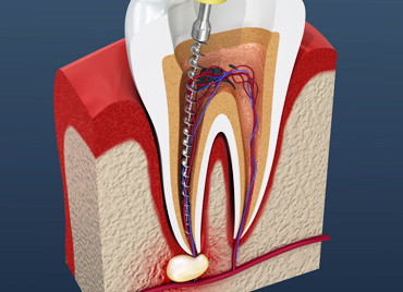 Удаление нерва в зубе: зачем, когда и как, можно ли это сделать самостоятельно
